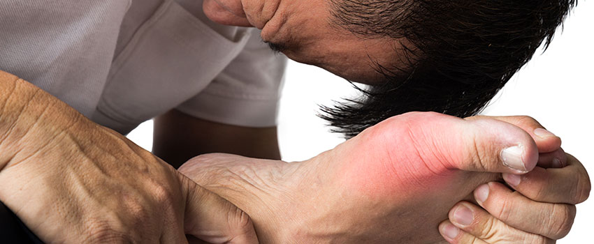 What to Know About Gout