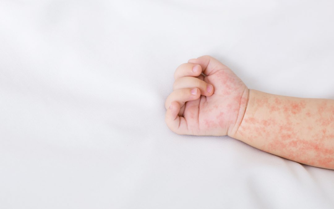Should My Child Be Vaccinated Against Measles?