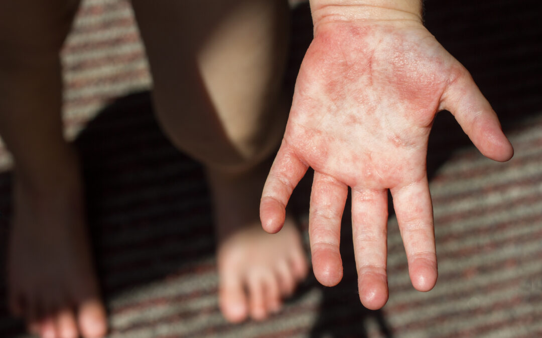 Understanding Measles: Transmission, Prevention, and Recovery  